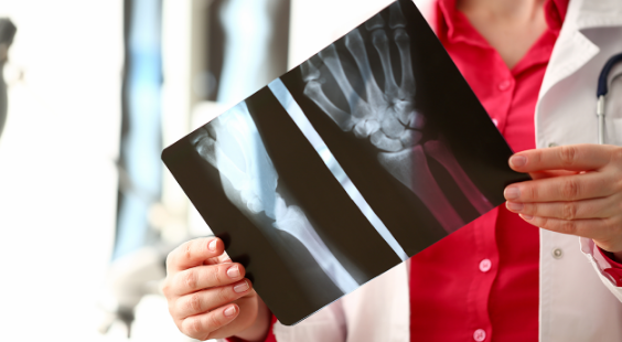 spondyloarthrite axiale